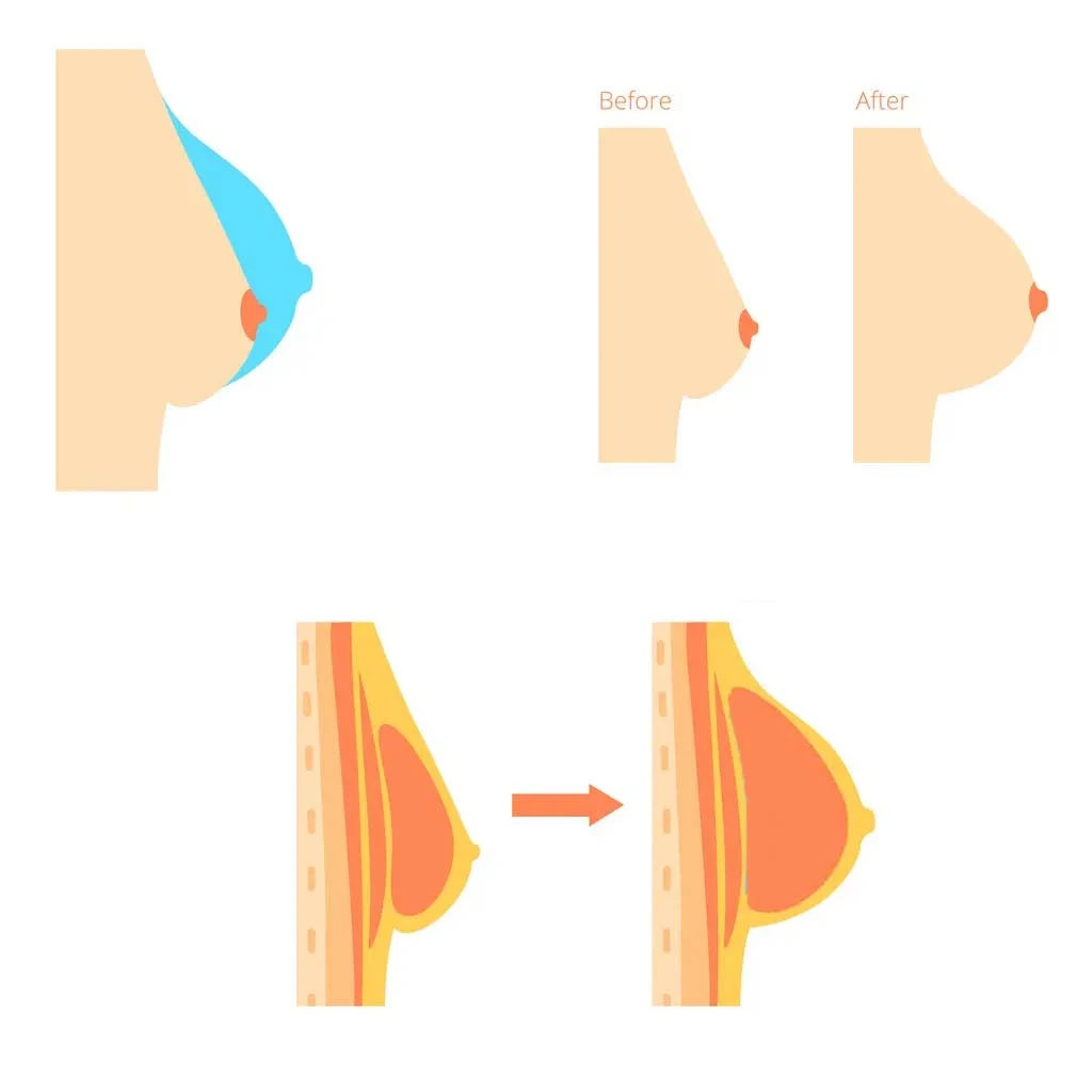 breast enhancement